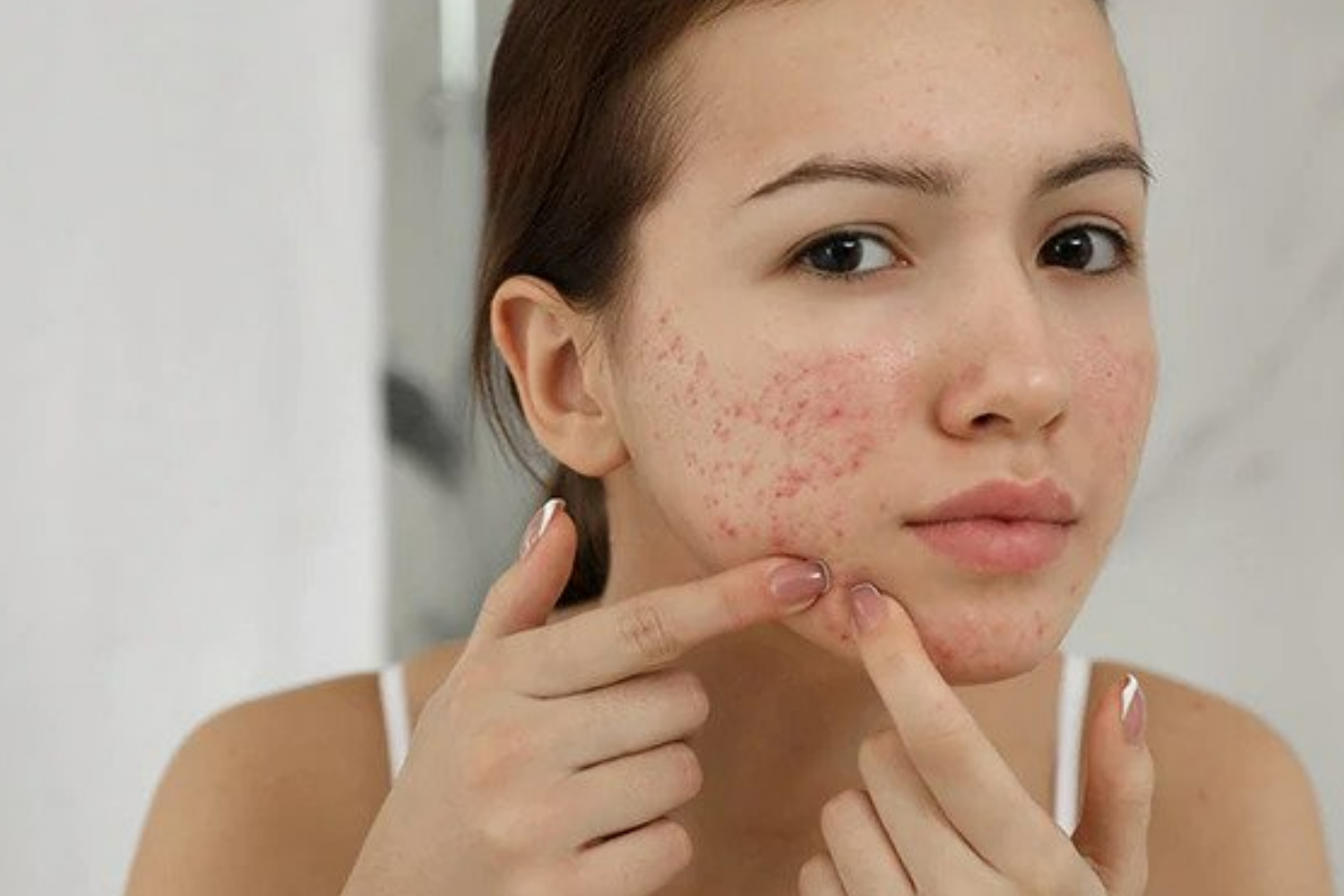 10 Awesome Skincare Benefits of Benzoyl Peroxide