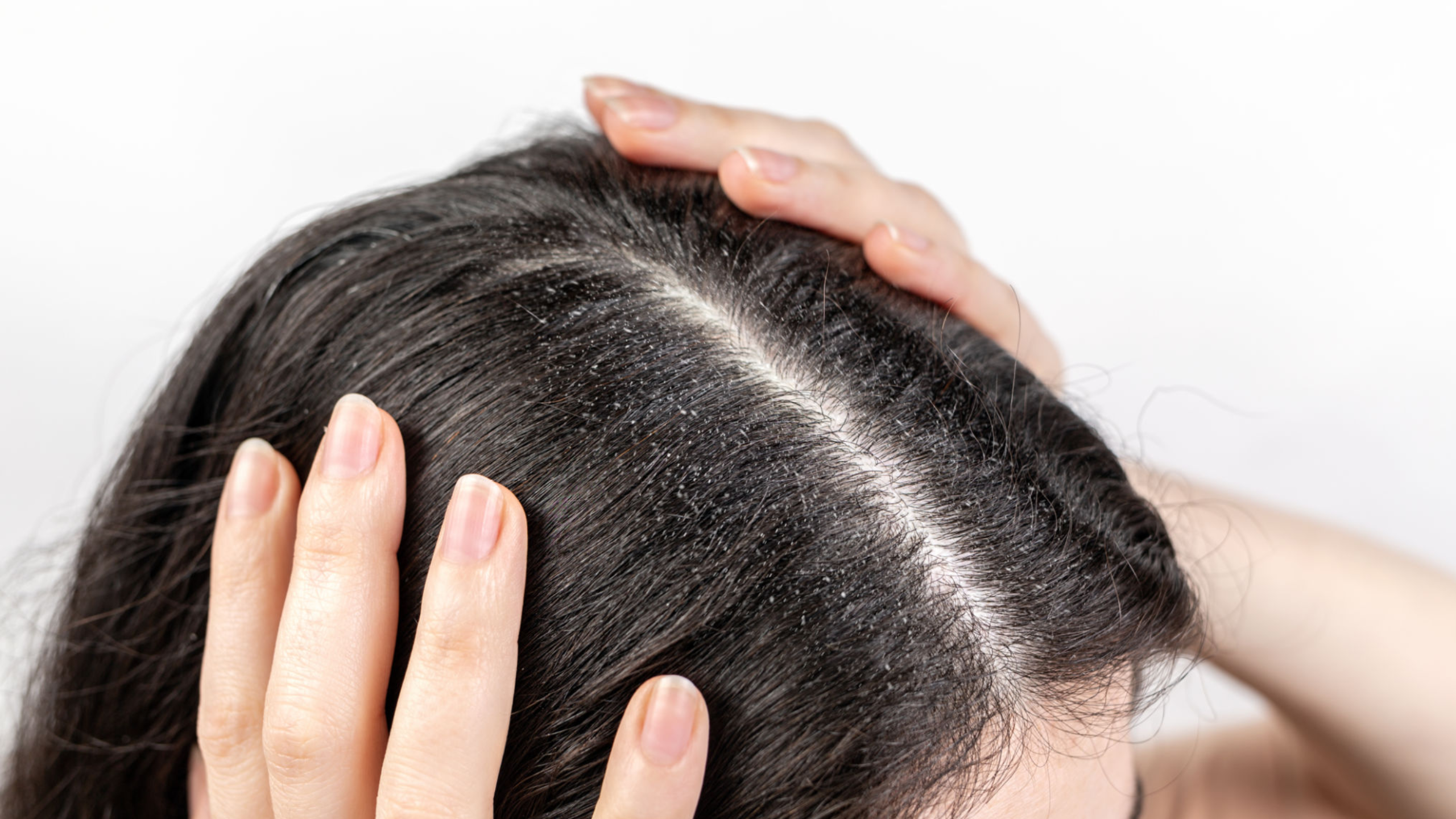 8 Effective and Natural Treatments to Get Rid of Dandruff